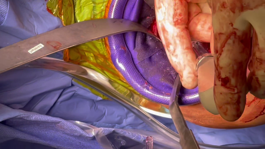 Glenoid Baseplate Insertion With Facilitator In Place